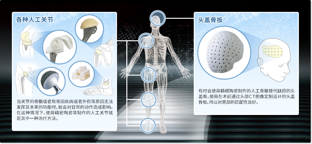 精密陶瓷用在了人体之中？